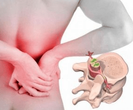 Lumbago ligos pradžioje osteochondrozės pradžioje