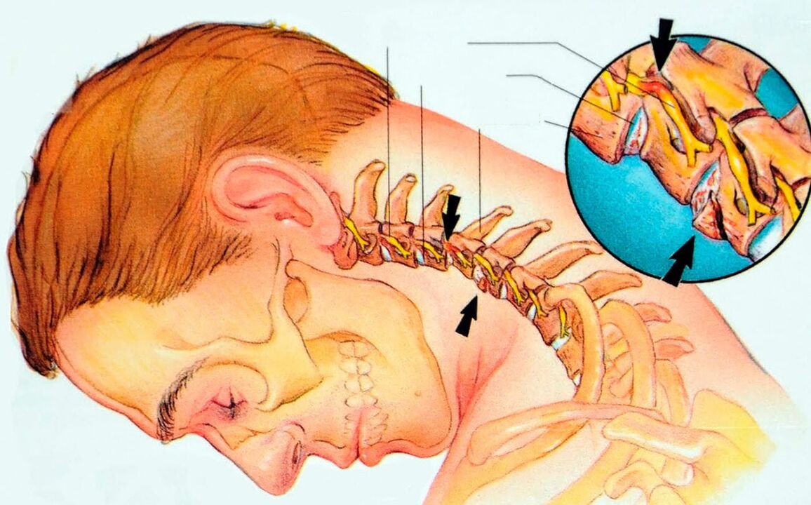 Kas yra gimdos kaklelio osteochondrozė
