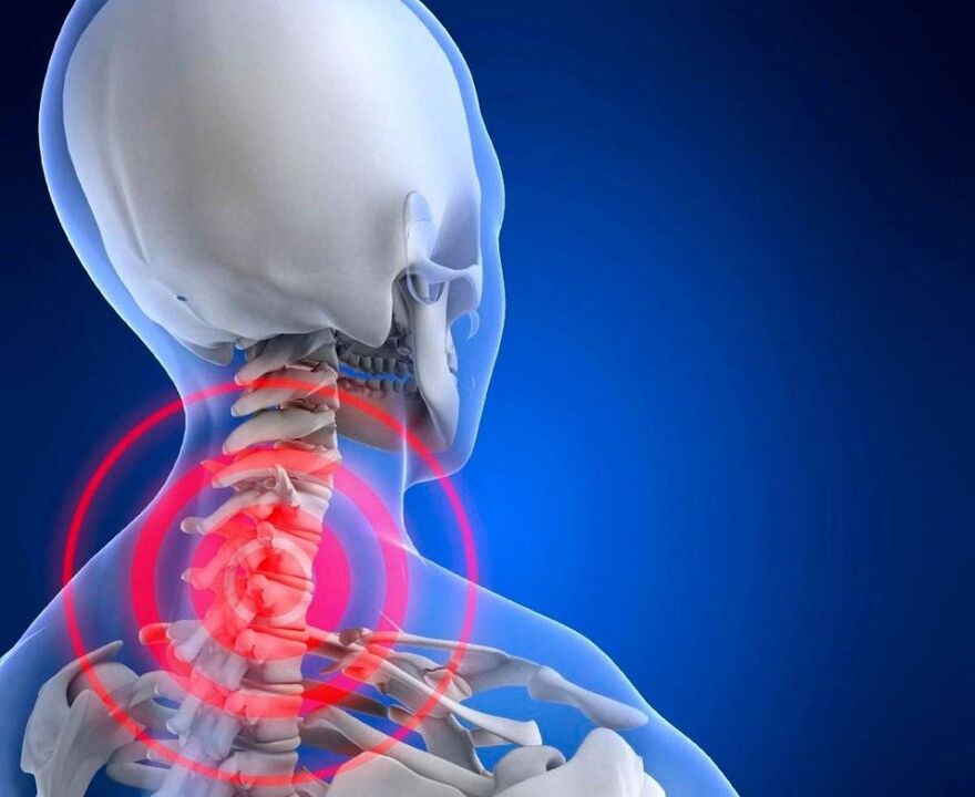 kaklo skausmas gimdos kaklelio osteochondroze
