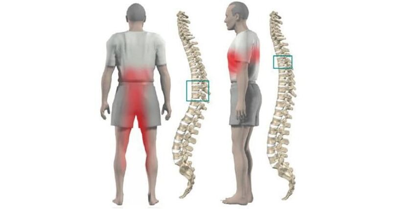 kūno ir stuburo skausmas su osteochondroze