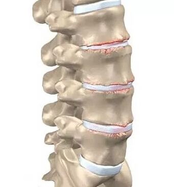Osteochondrozė